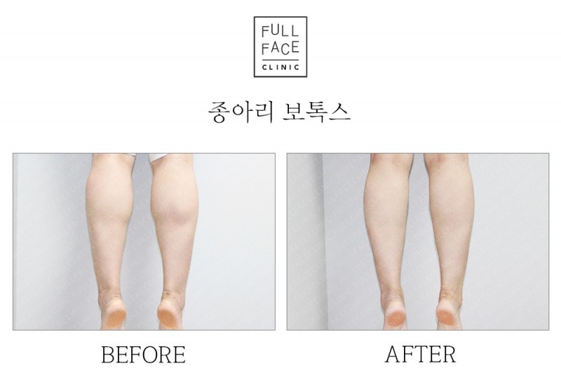 종아리보톡스(19.9.9→19.10.14)