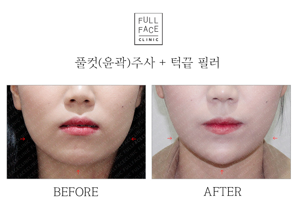 턱끝필러+윤곽주사(19.6.12→19.9.24)