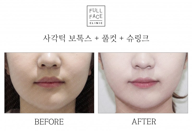 사각턱보톡스+풀컷+슈링크(20.5.28→20.10.7)