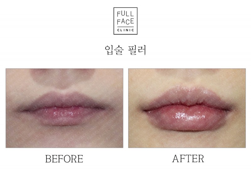 입술필러(19.12.16→20.1.14)