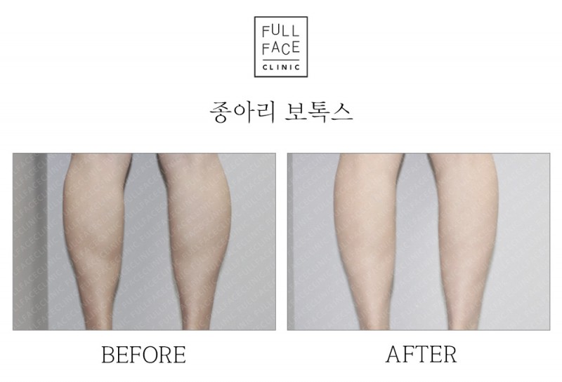 종아리보톡스(20.2.5→20.3.24)