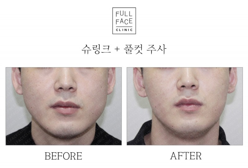 슈링크리프팅+풀컷주사(20.1.9→20.2.28)