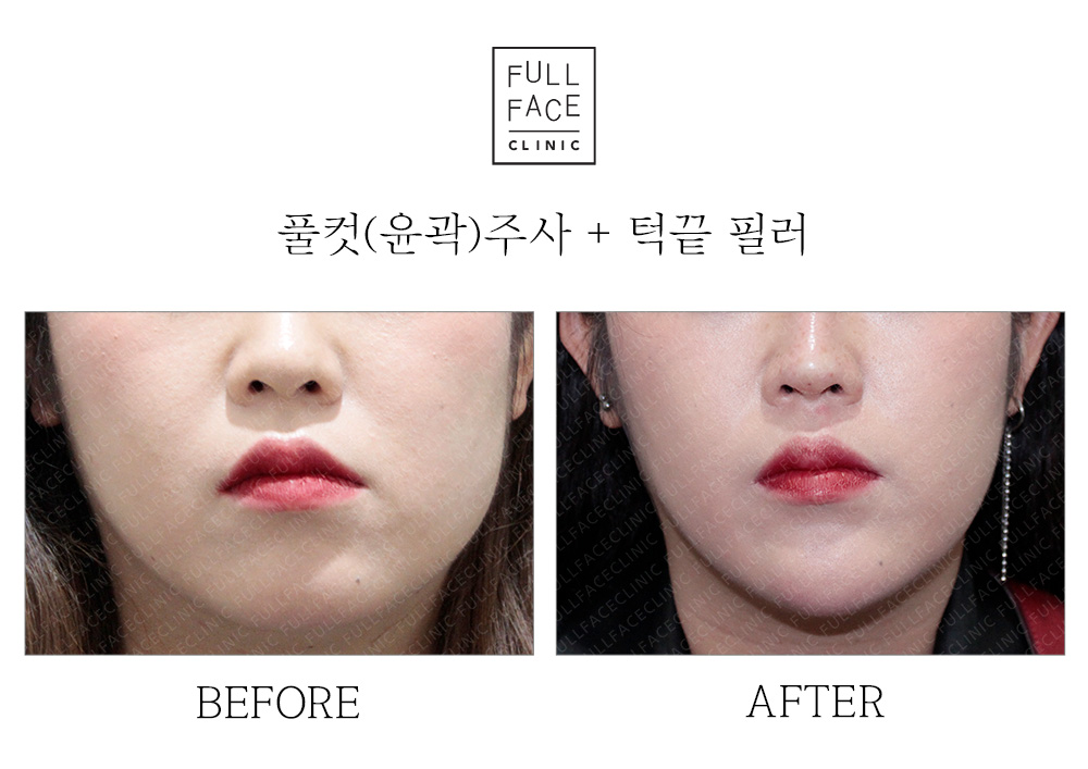 윤곽주사+턱끝필러(19.10.5→19.12.7)