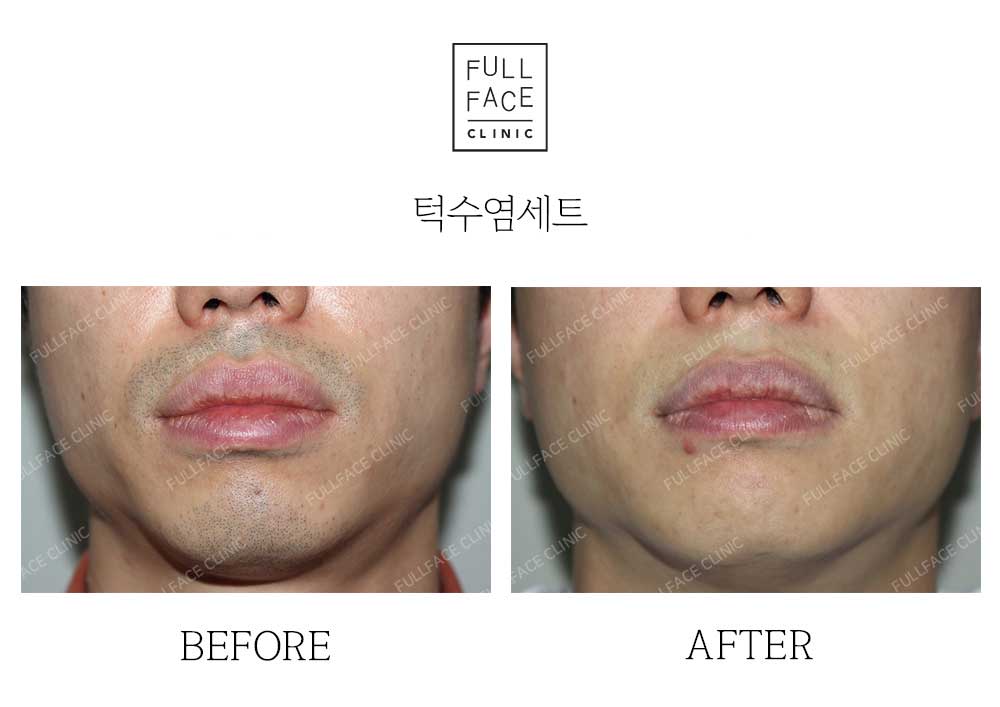 턱수염세트제모(23.5.26→24.7.12)