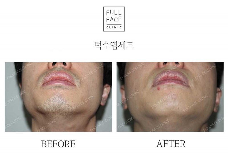 턱수염세트제모(23.5.26→24.7.12)