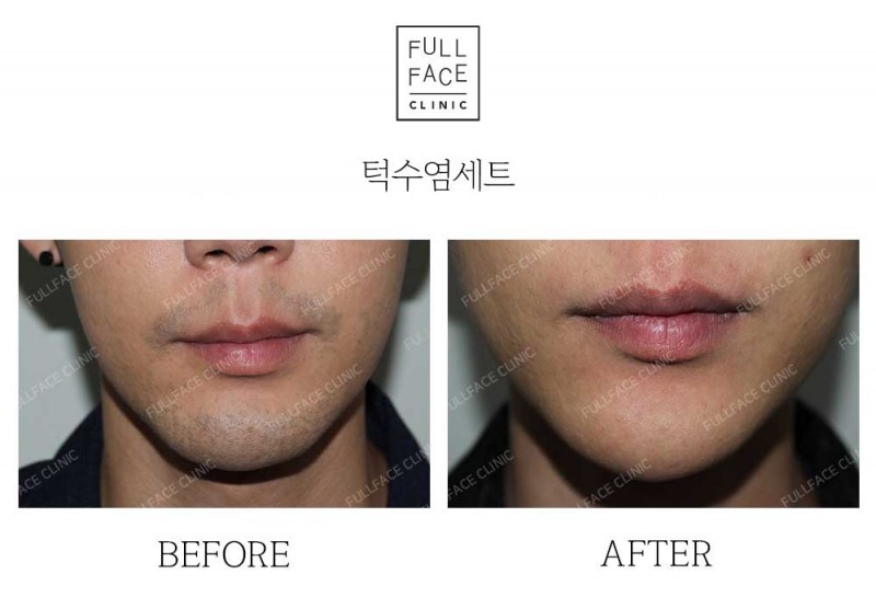 턱수염세트제모(22.5.31→24.9.30)