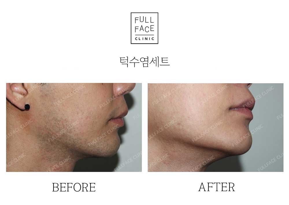 턱수염세트제모(22.5.31→24.9.30)
