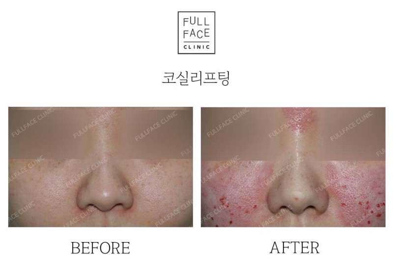 시그니처올림포스코프팅(24.9.11.4→24.11.11)