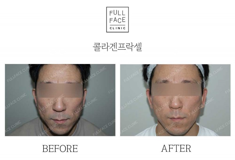 시그니처 콜라겐프락셀(24.1.13→24.6.8)