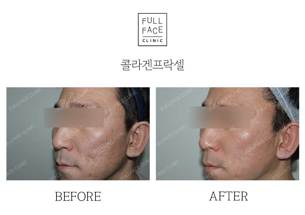 시그니처 콜라겐프락셀(24.1.13→24.6.8)