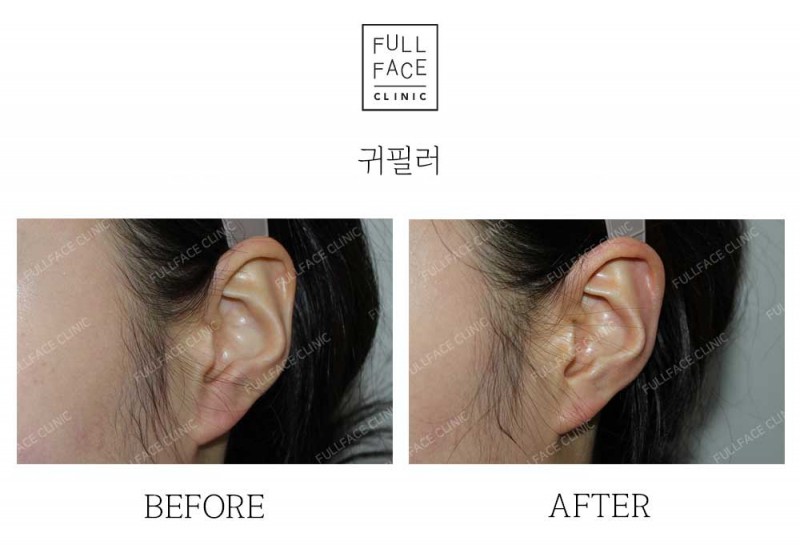 특수필러