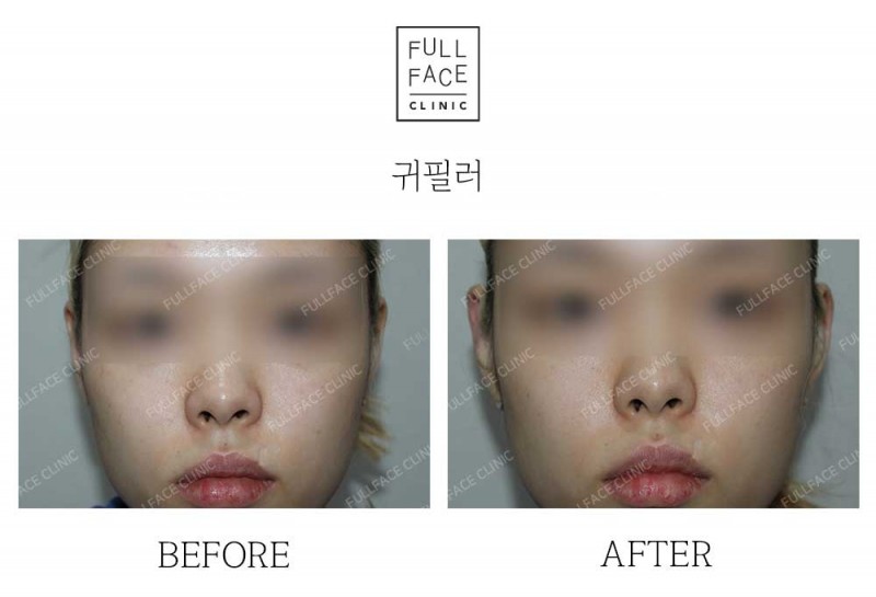 시그니처 스페셜디자인 귀필러(24.11.22→24.12.29)