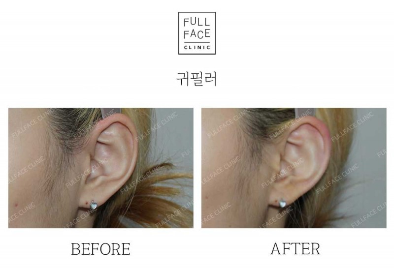 시그니처 스페셜디자인 귀필러(24.11.22→24.12.29)