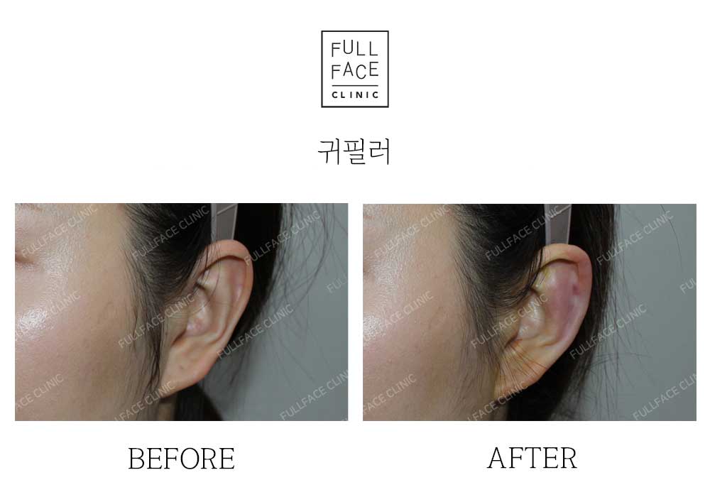 시그니처 스페셜디자인 귀필러(24.11.21→24.12.19)