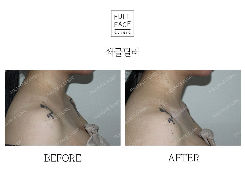 시그니처 스페셜 쇄골필러(25.5.25→시술직후)