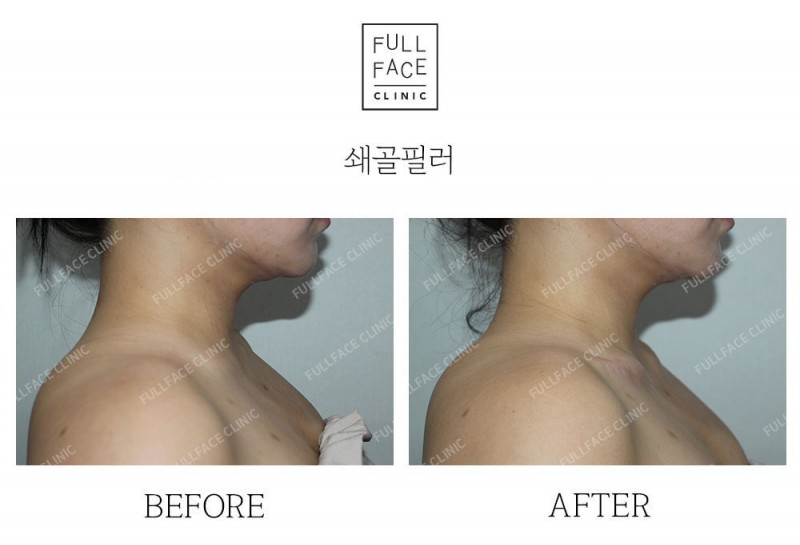 시그니처 스페셜 쇄골필러(25.5.15→시술직후)