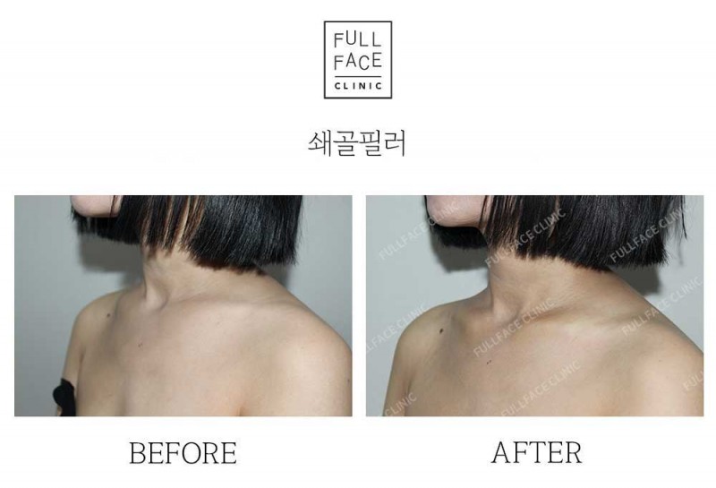 시그니처 스페셜 쇄골필러(25.4.14→시술직후)