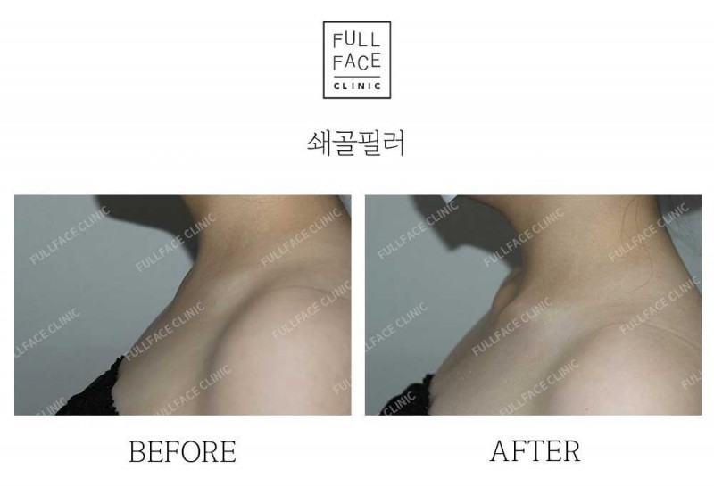 시그니처 스페셜 쇄골필러(25.5.3→시술직후)
