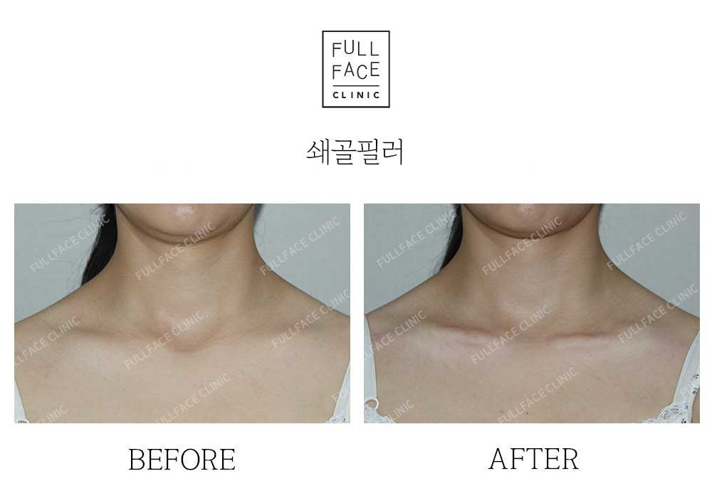 시그니처 스페셜 쇄골필러(25.5.25→시술직후)
