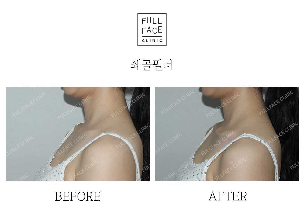 시그니처 스페셜 쇄골필러(25.5.25→시술직후)
