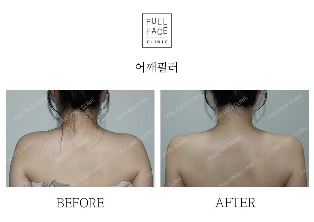 시그니처 스페셜 어깨필러(25.8.5→시술직후)