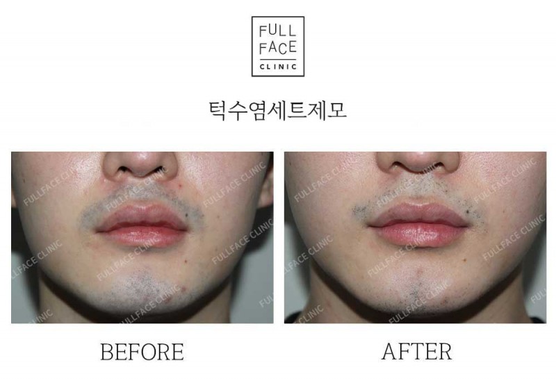 턱수염세트제모(25.5.6→25.7.27)