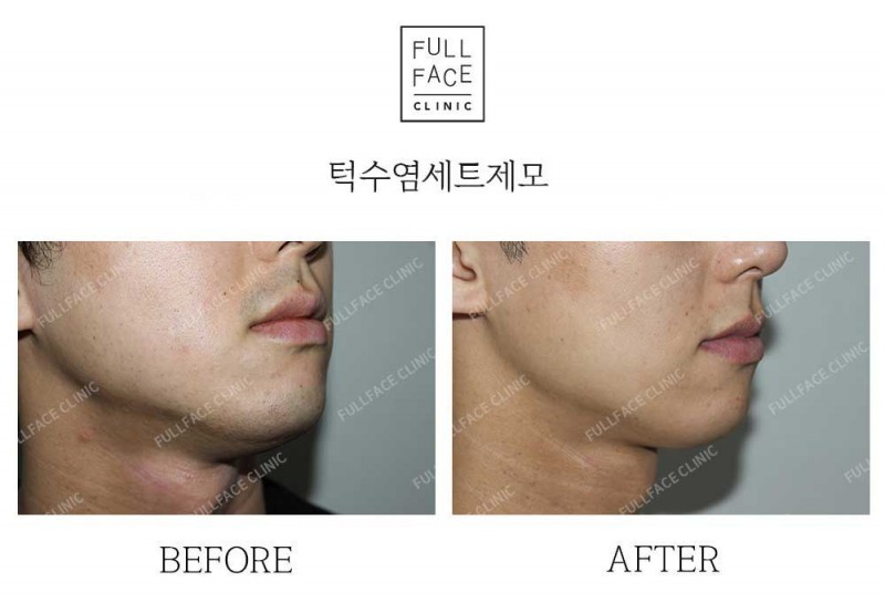 턱수염세트제모(25.5.6→25.7.27)