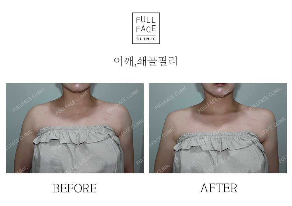 시그니처스페셜 쇄골+어깨필러(25.9.18→25.10.21)