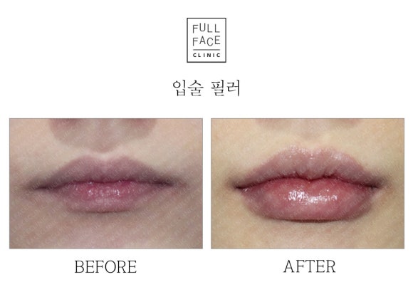홍대 입술필러 잘하는곳 ? 후기만 믿지는 마세요.