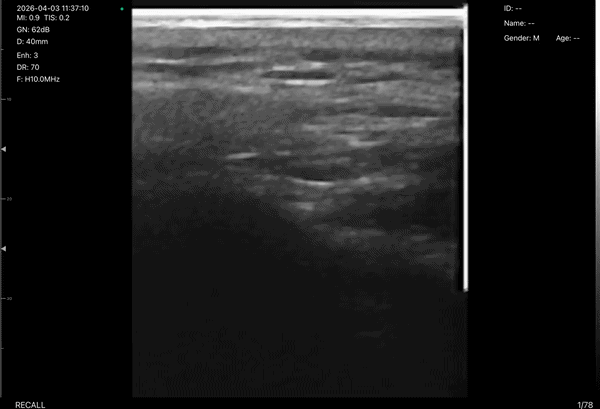 Ultrasound-guided body botox